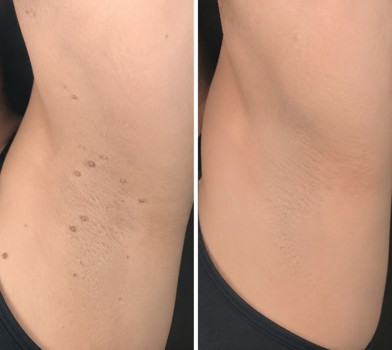 ✨Elmstr®2-in-1 Microneedle & Hydrocolloid Patch🍀| Removes Raised Moles, Acne, Flat Warts & Skin Tags | Helps Improve Wrinkles, Scars & Blemishes | Invisible Patches for Face & Body