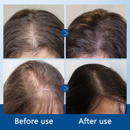 Regenx™ Hair Growth Serum Roll-on
